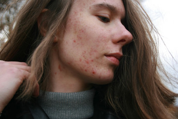 Junge Frau mit Gesichtsrötungen