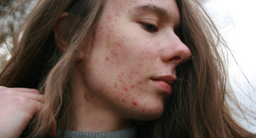 Junge Frau mit Gesichtsrötungen
